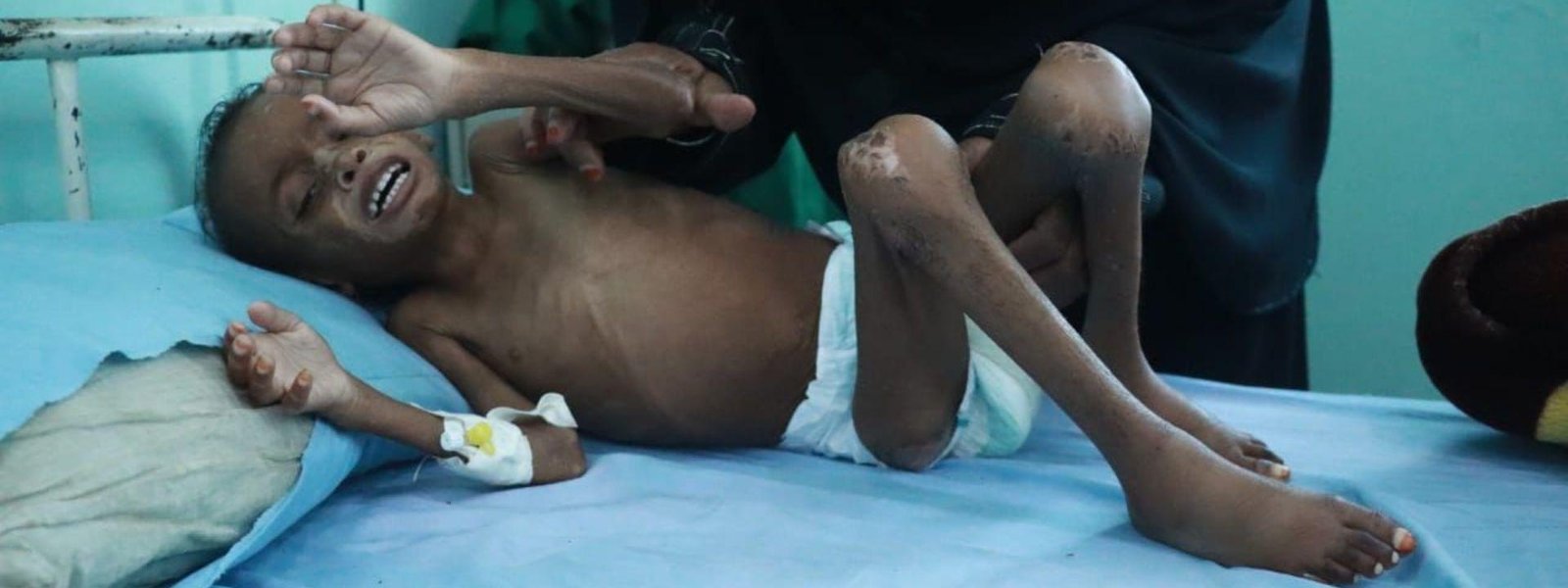 Yemen Malnutrition